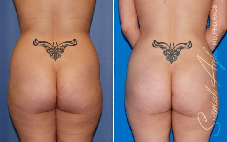 Combined Tummy Tuck and Brazilian Butt Lift Patient Newport Beach, CA