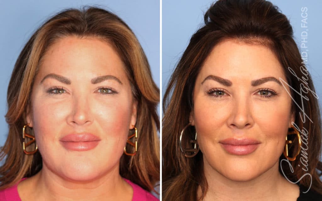 Facelift Landing Page New