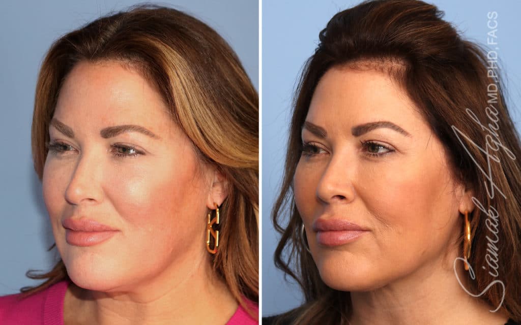 Facelift Landing Page New