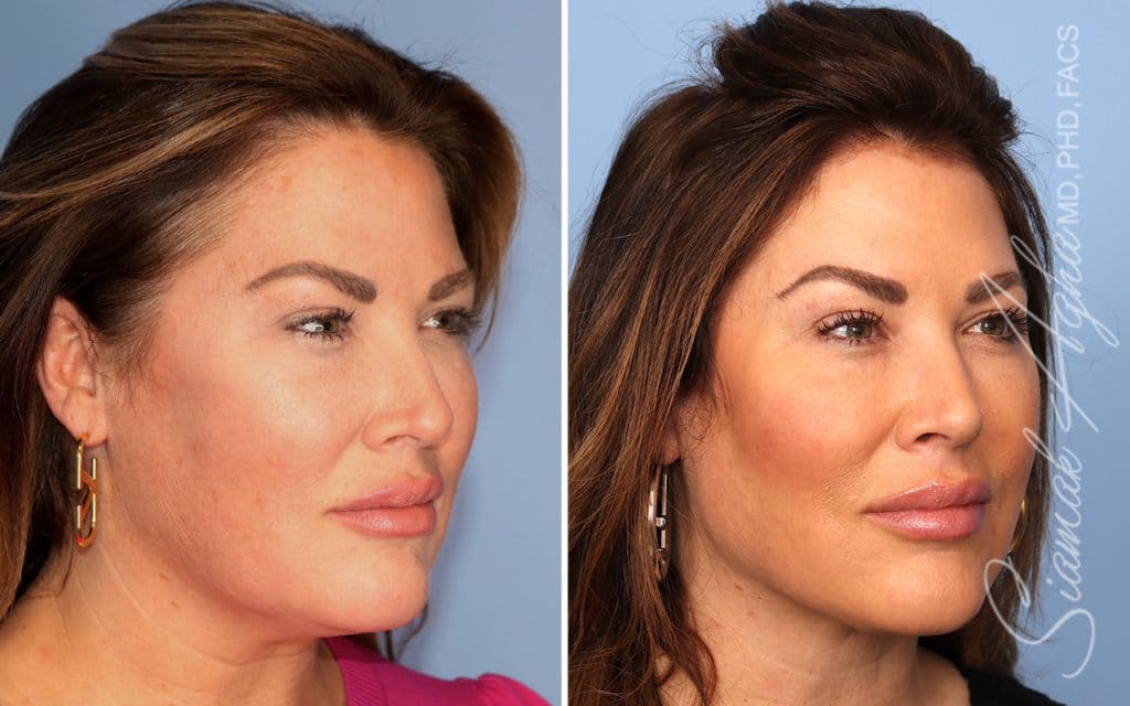Facelift Landing Page New