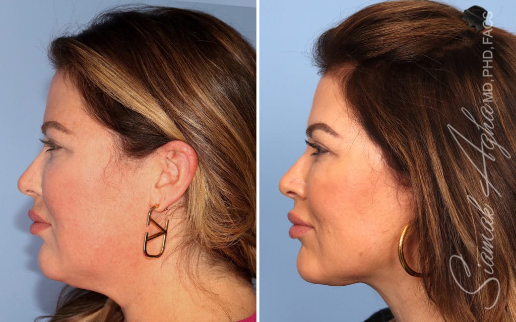 Facelift Landing Page New