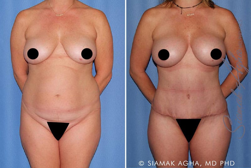 Mommy Makeover Surgery in Newport Beach, CA