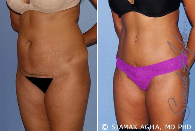 High-Definition Tummy Tuck by Dr. Agha