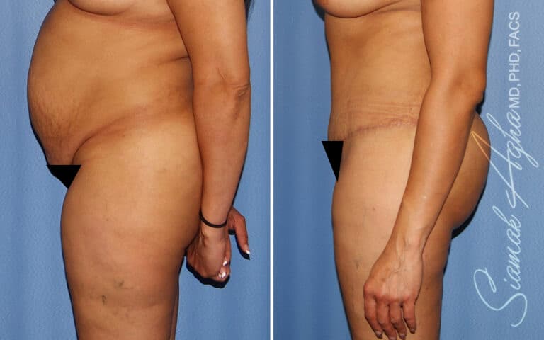 High-Definition Tummy Tuck by Dr. Agha