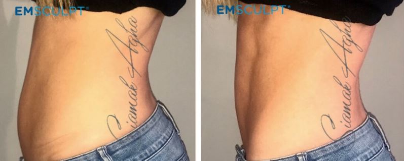 Emsculpt Before & After - Female - Abdomen Side