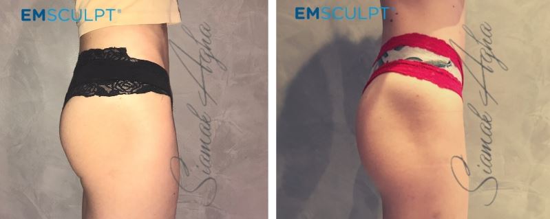 Emsculpt Before & After - Female - Buttocks Side