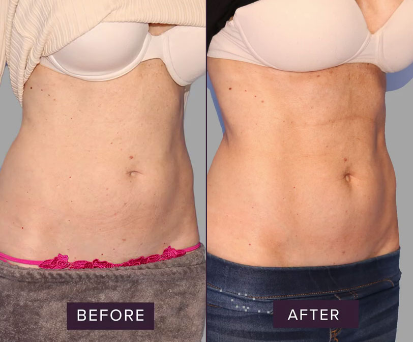 Emsculpt Before & After - Peggy Tanous RHOC - Front Right