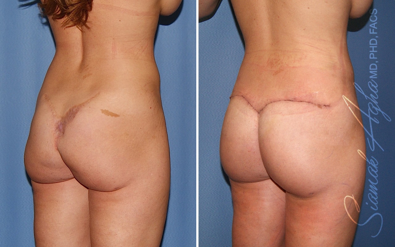 Buttock Correction Before &#038; After Photos