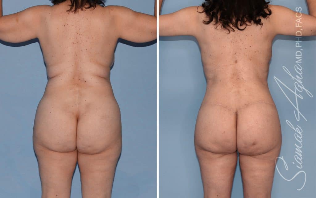 Lower Body Lift Surgery