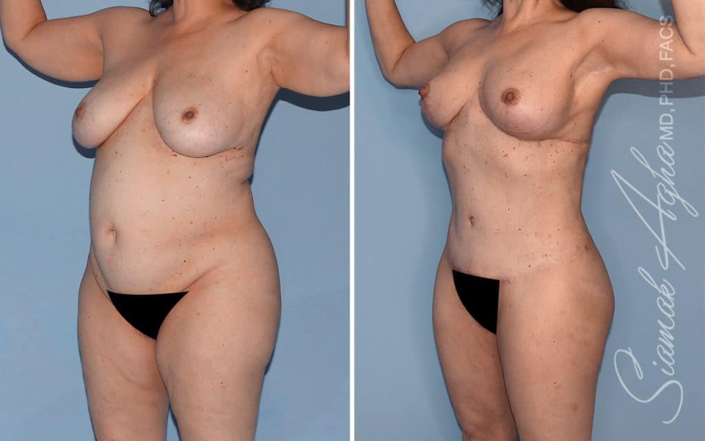 Lower Body Lift Surgery