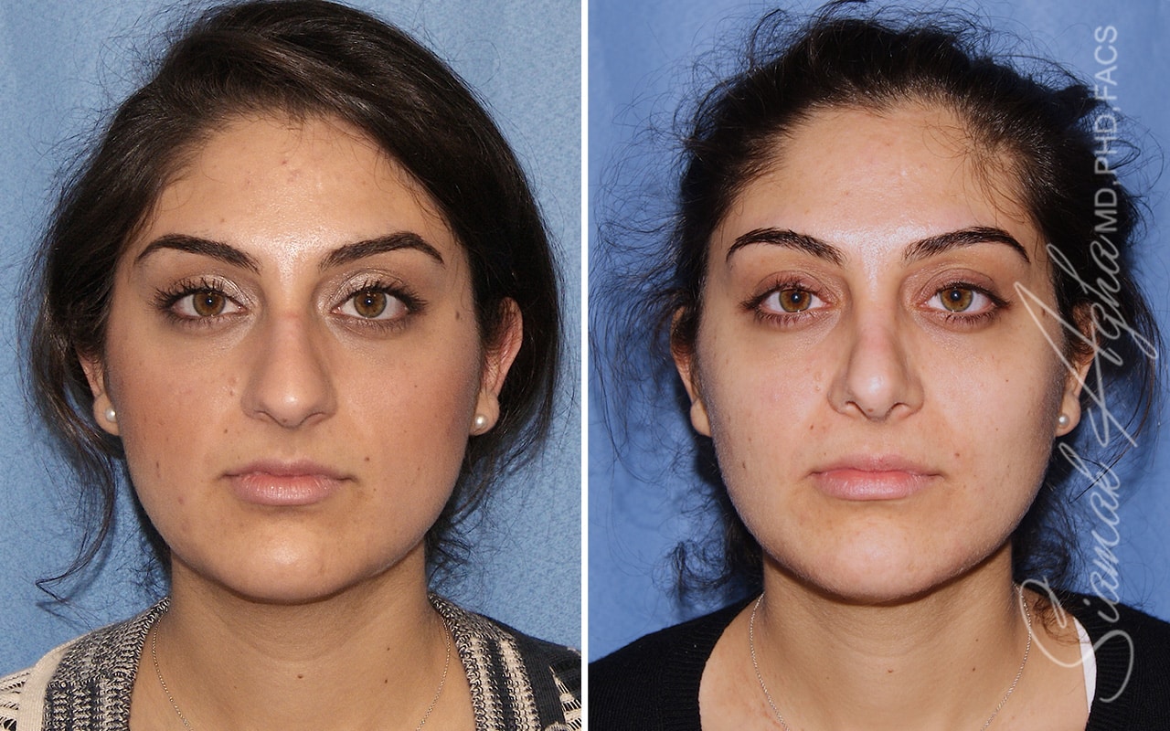 Rhinoplasty &#8211; Dr Agha