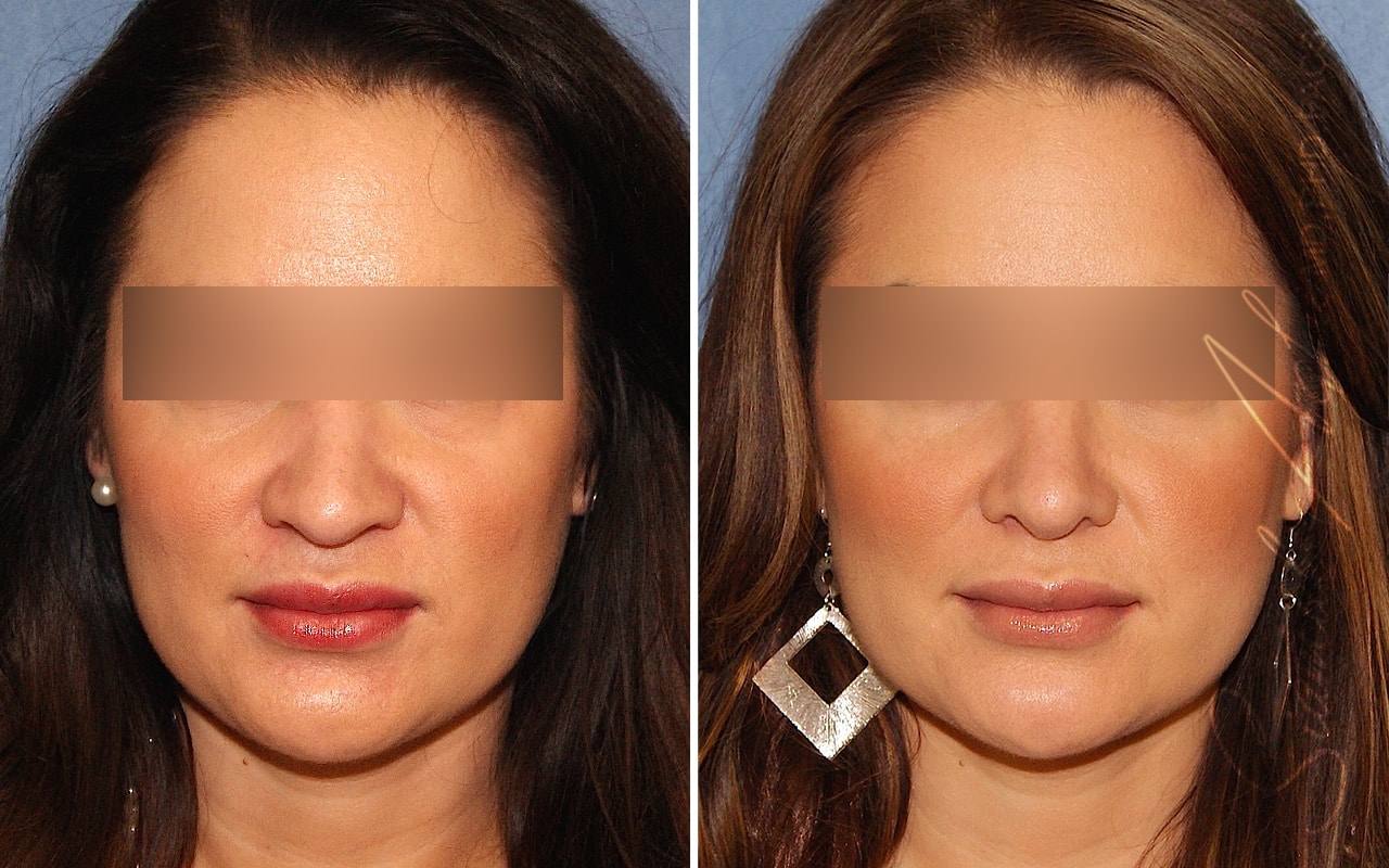 Rhinoplasty &#8211; Dr Agha