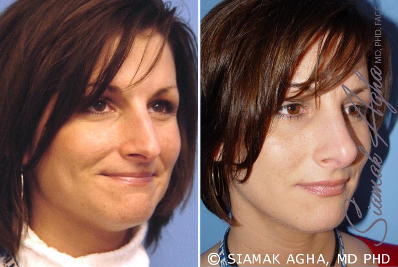 Rhinoplasty &#8211; Dr Agha