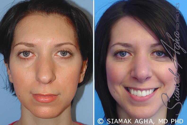 Rhinoplasty &#8211; Dr Agha