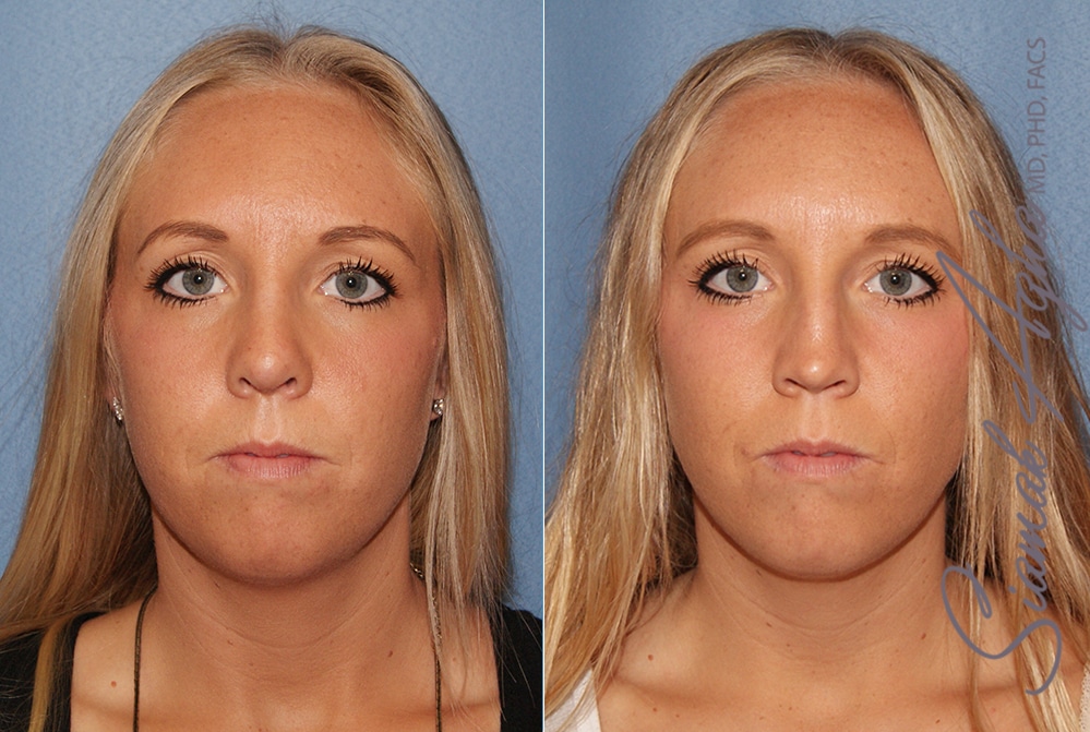 Rhinoplasty &#8211; Dr Agha