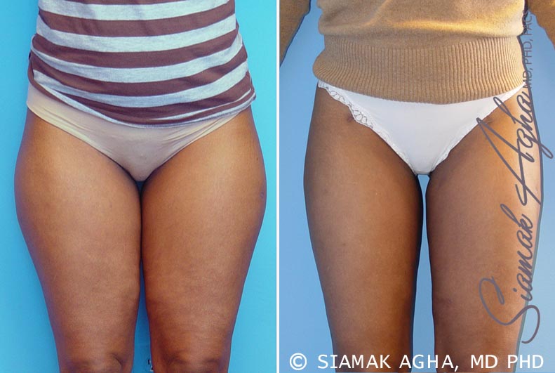 Liposuction