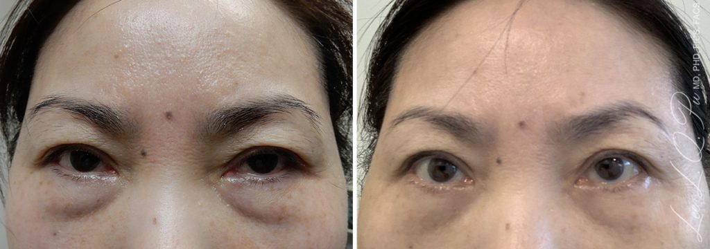 Dr. Pu&#8217;s Before and After Photos