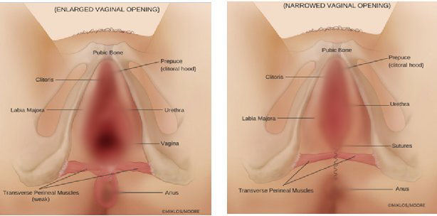 Vaginal Rejuvenation and Other Female Genital Cosmetic Surgery