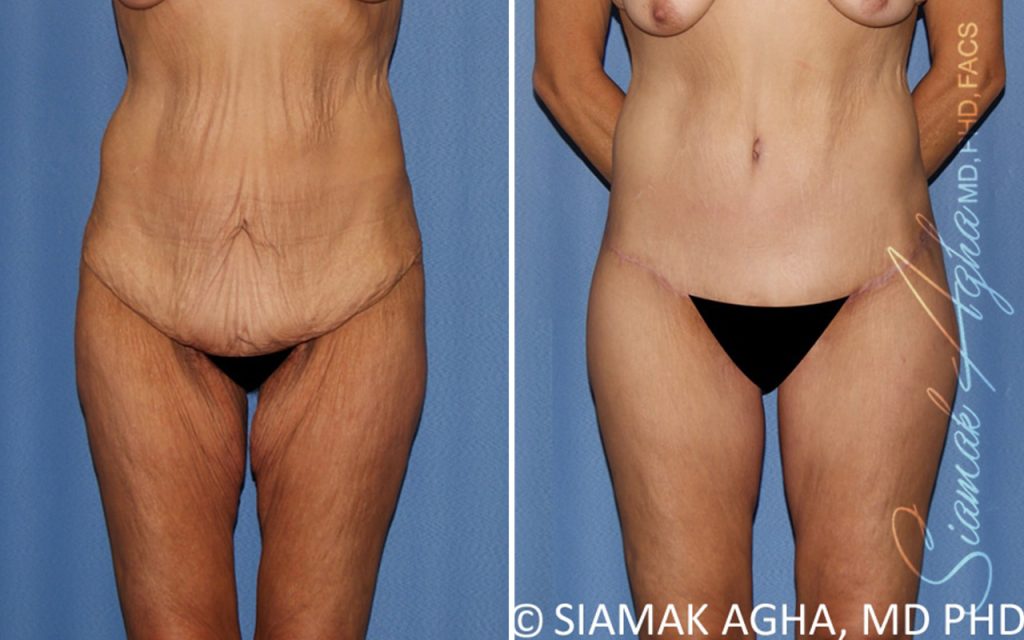 Plastic Surgery After GLP-1 Medications