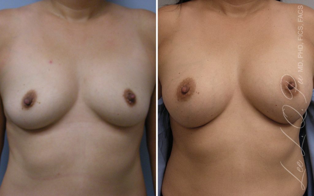 Dr Pu&#8217;s Breast &#038; Body Before And After Photos