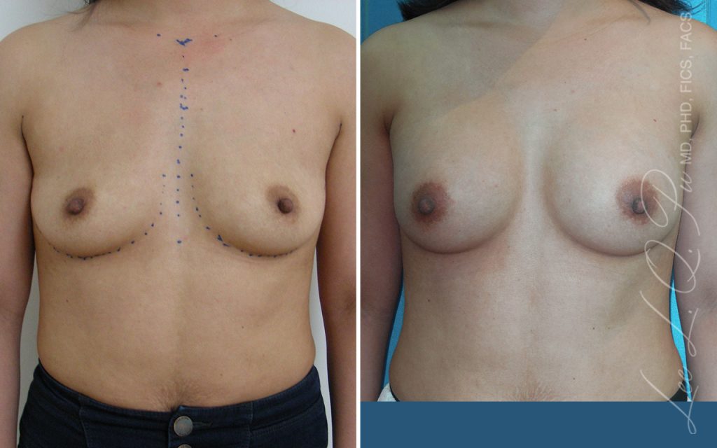 Dr Pu&#8217;s Breast &#038; Body Before And After Photos