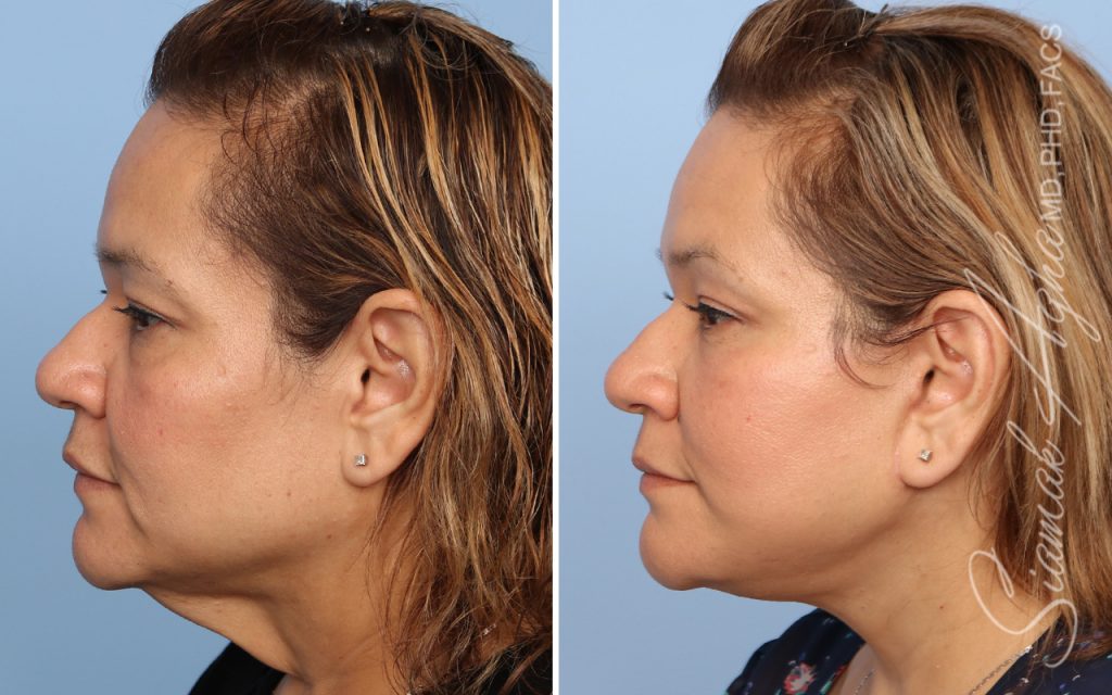 Facelift Landing Page New