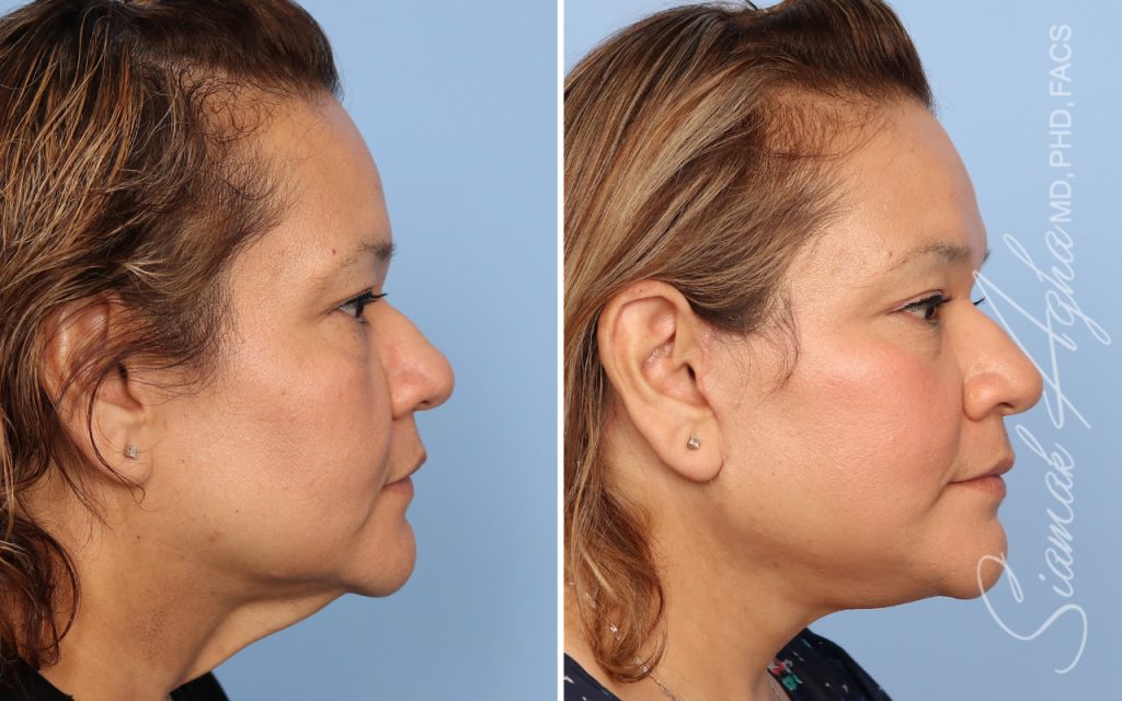 Facelift Landing Page New
