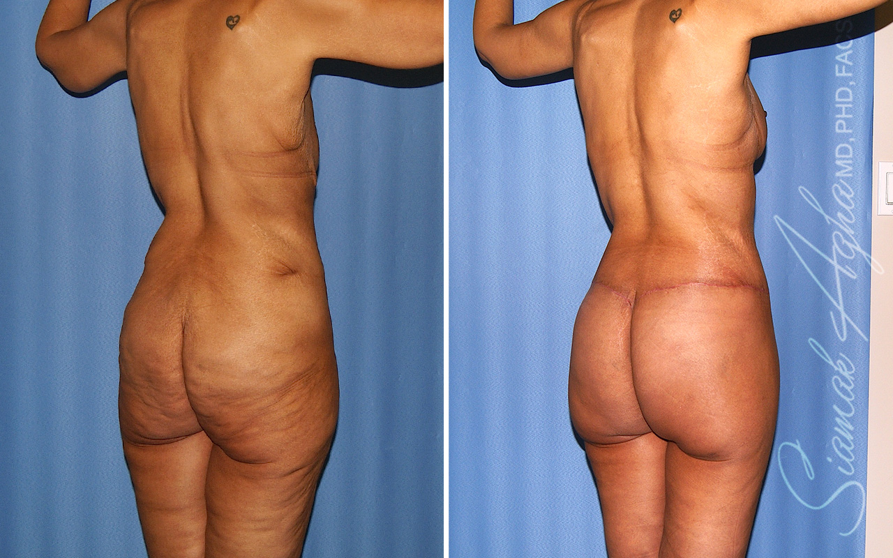 Total Body Lift Patient 66