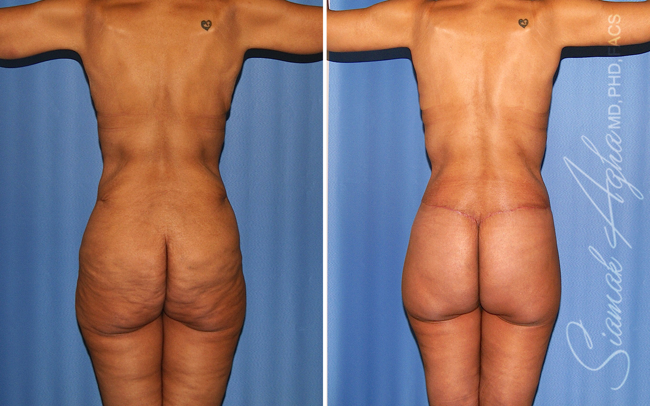 Total Body Lift Patient 66