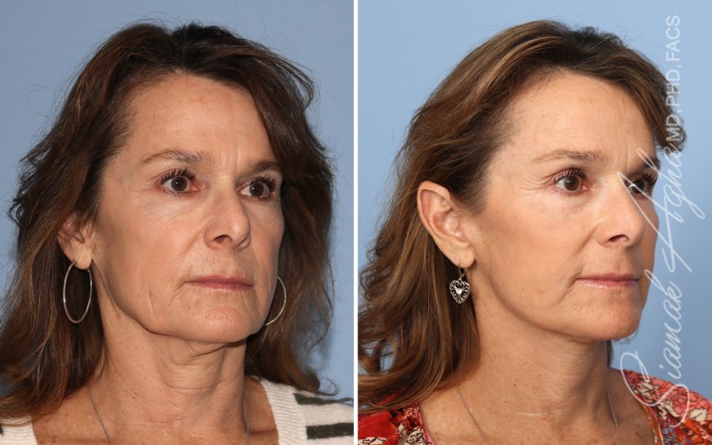Facelift Landing Page New