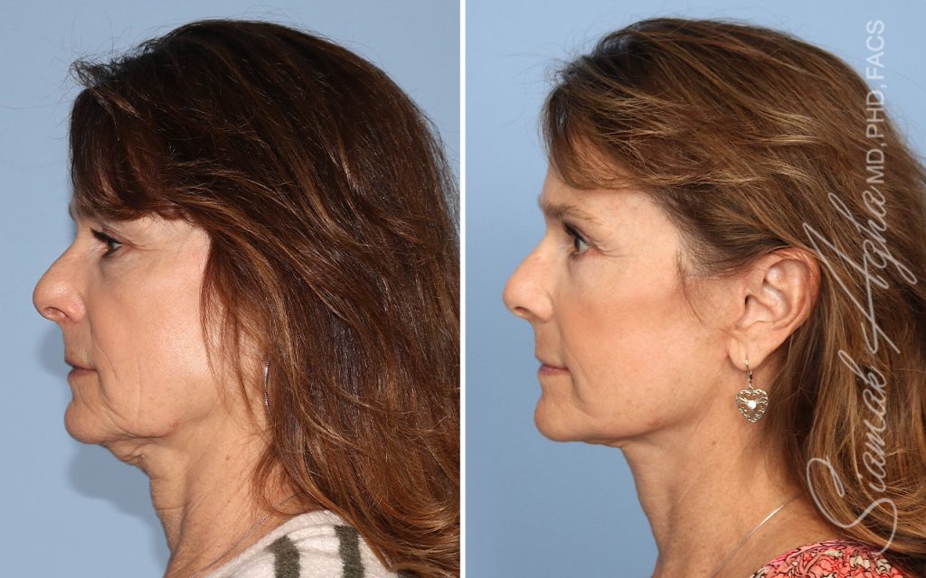 Facelift Landing Page New