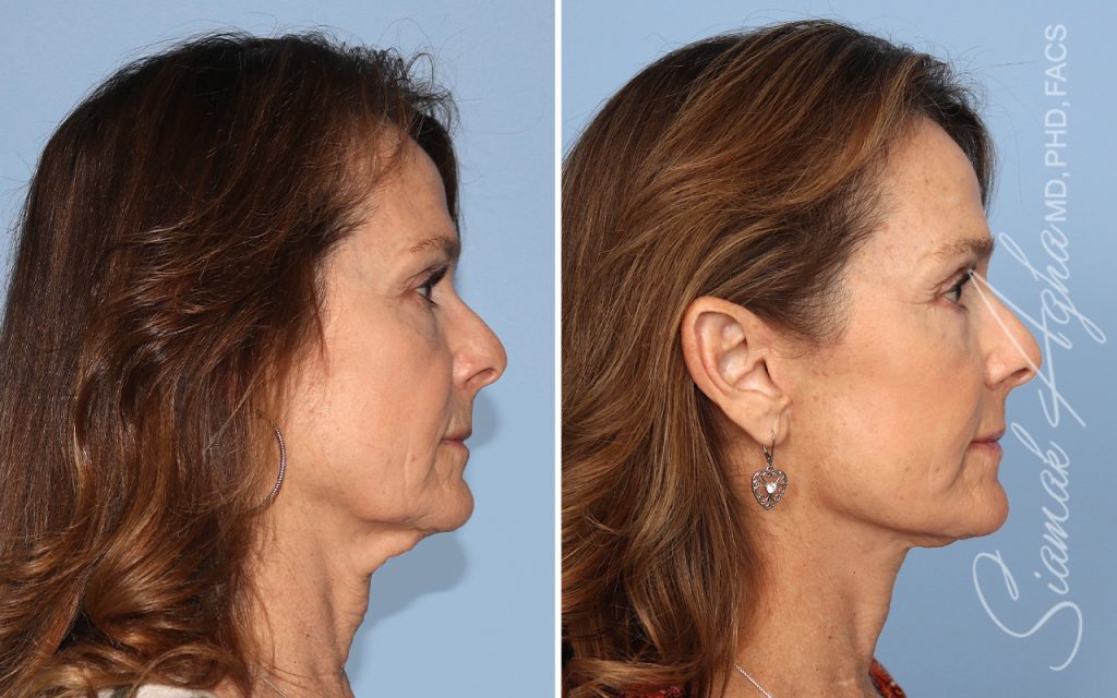 Facelift Landing Page New