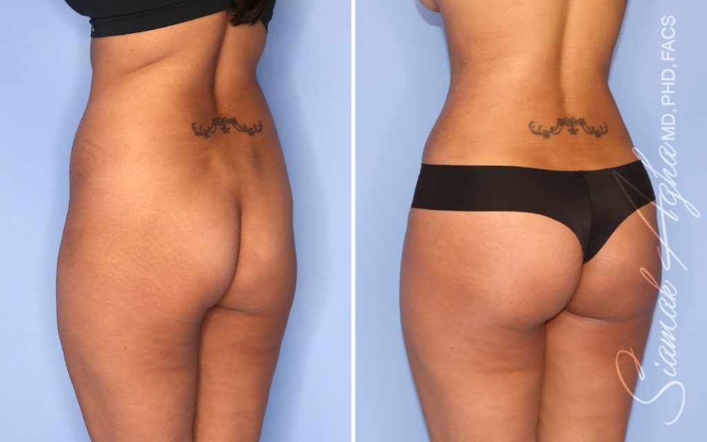 Plastic Surgery After GLP-1 Medications