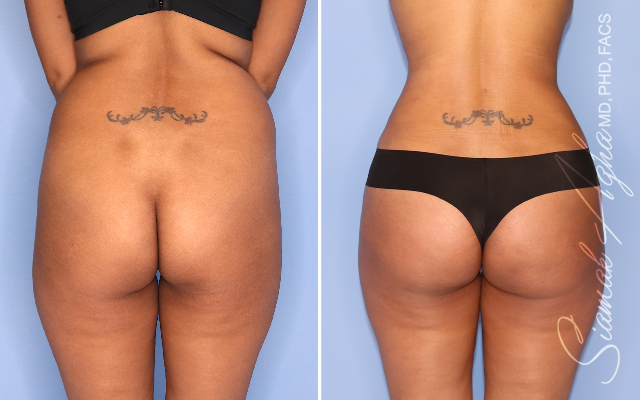 Brazilian Butt Lift - Before and After Photos of Patient 75