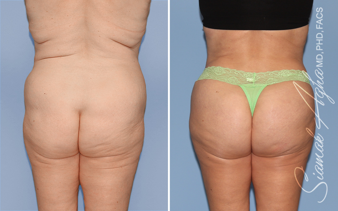Brazilian Butt Lift - Before and After Photos of Patient 76