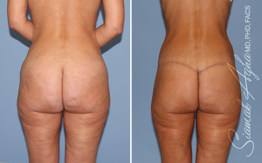 Lower Body Lift Surgery