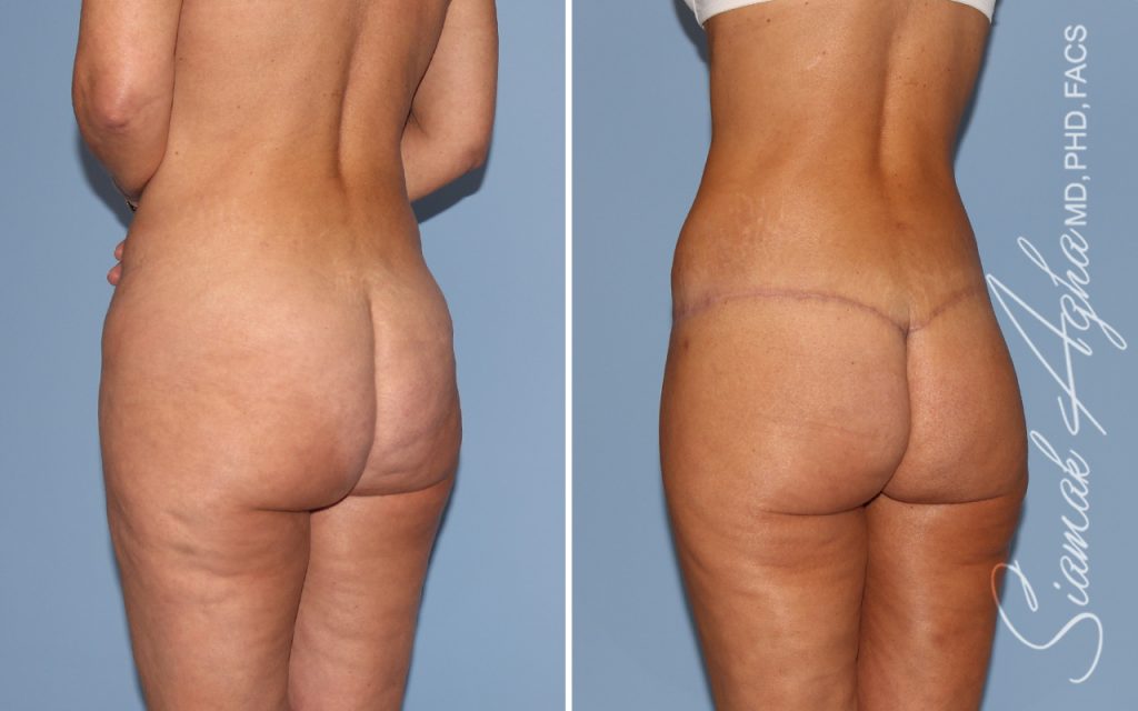 Lower Body Lift Surgery