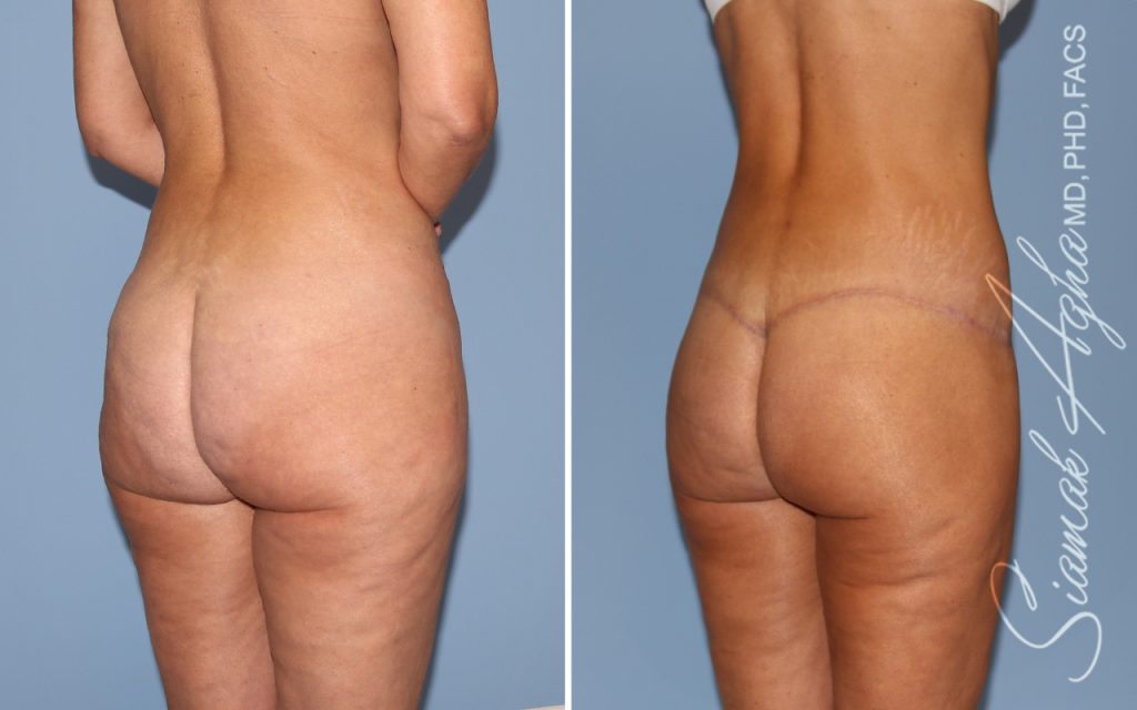 Lower Body Lift Surgery