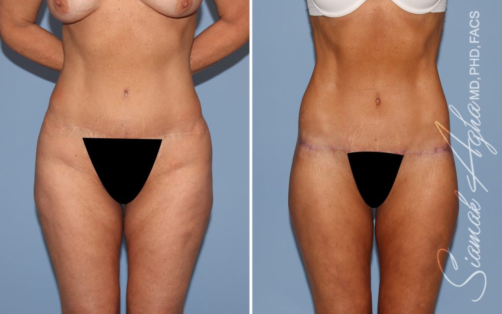 Lower Body Lift Surgery