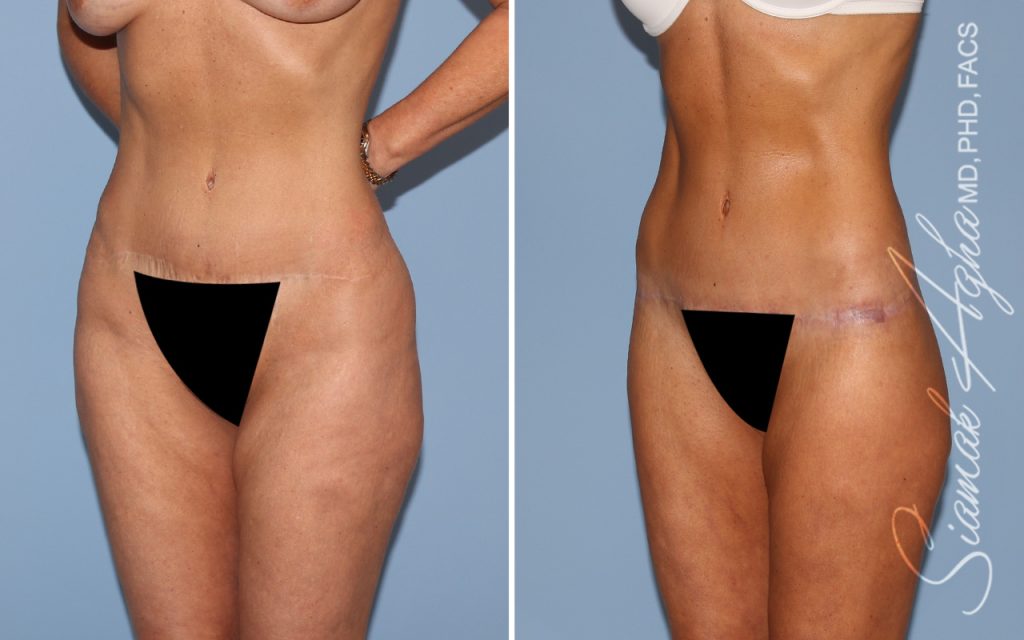 Lower Body Lift Surgery