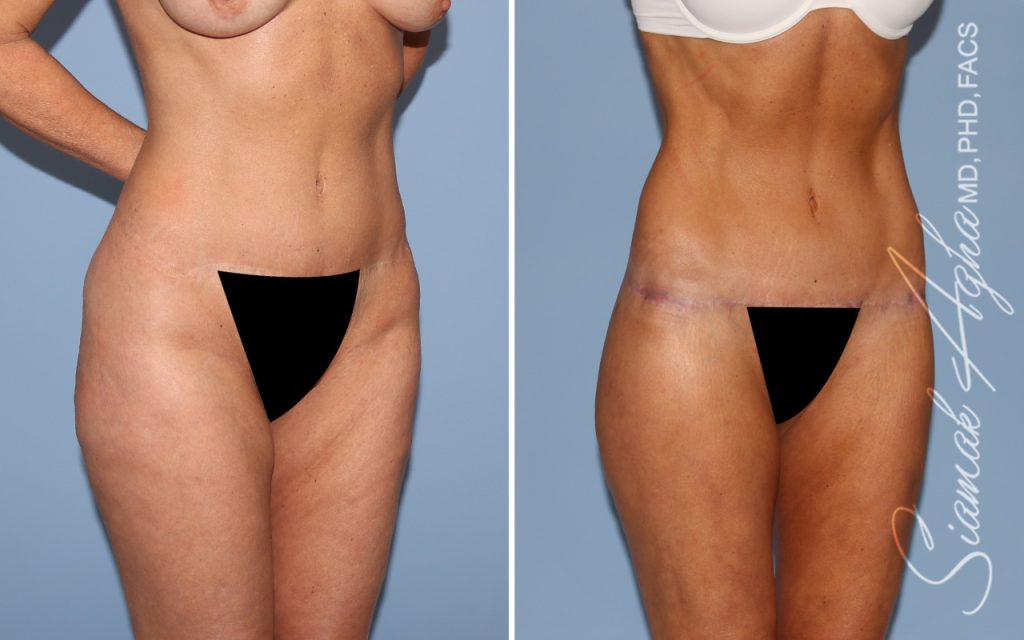 Lower Body Lift Surgery