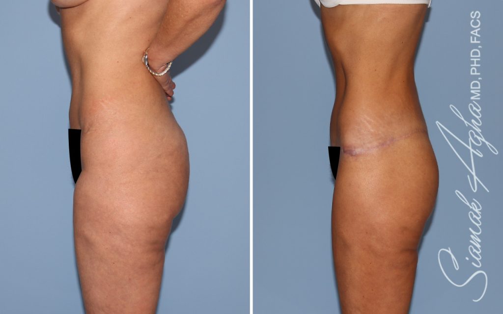 Lower Body Lift Surgery