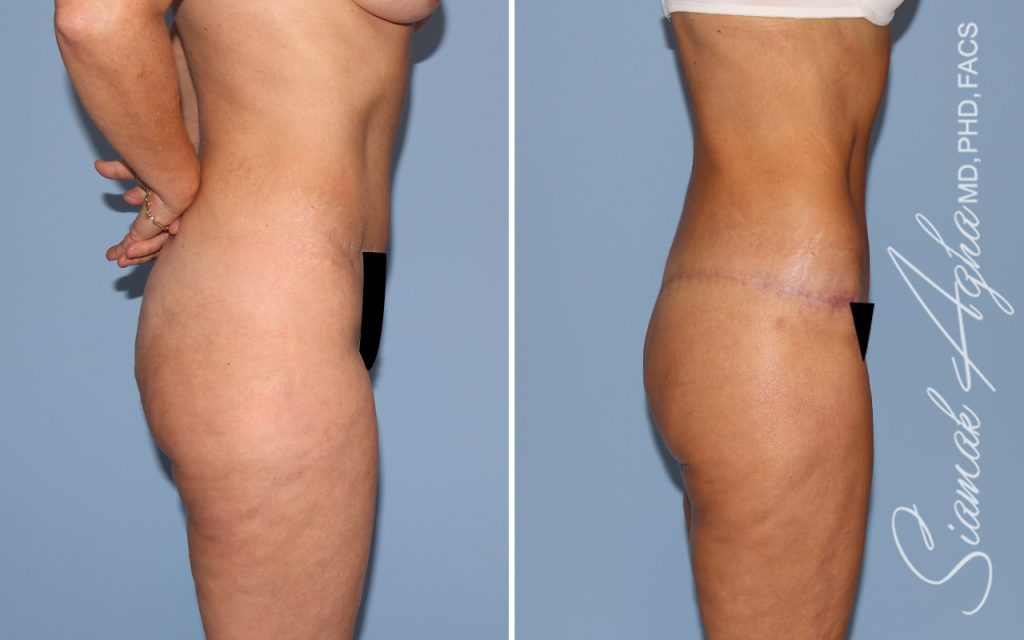 Lower Body Lift Surgery