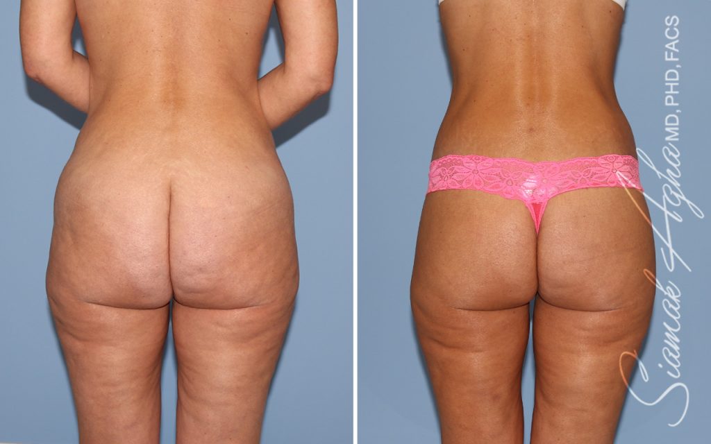 Lower Body Lift Surgery