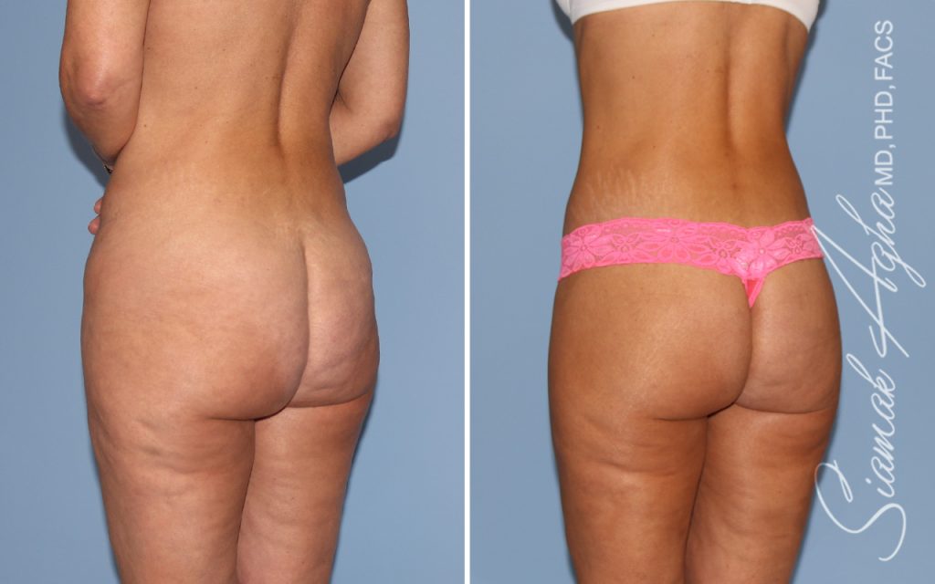 Lower Body Lift Surgery