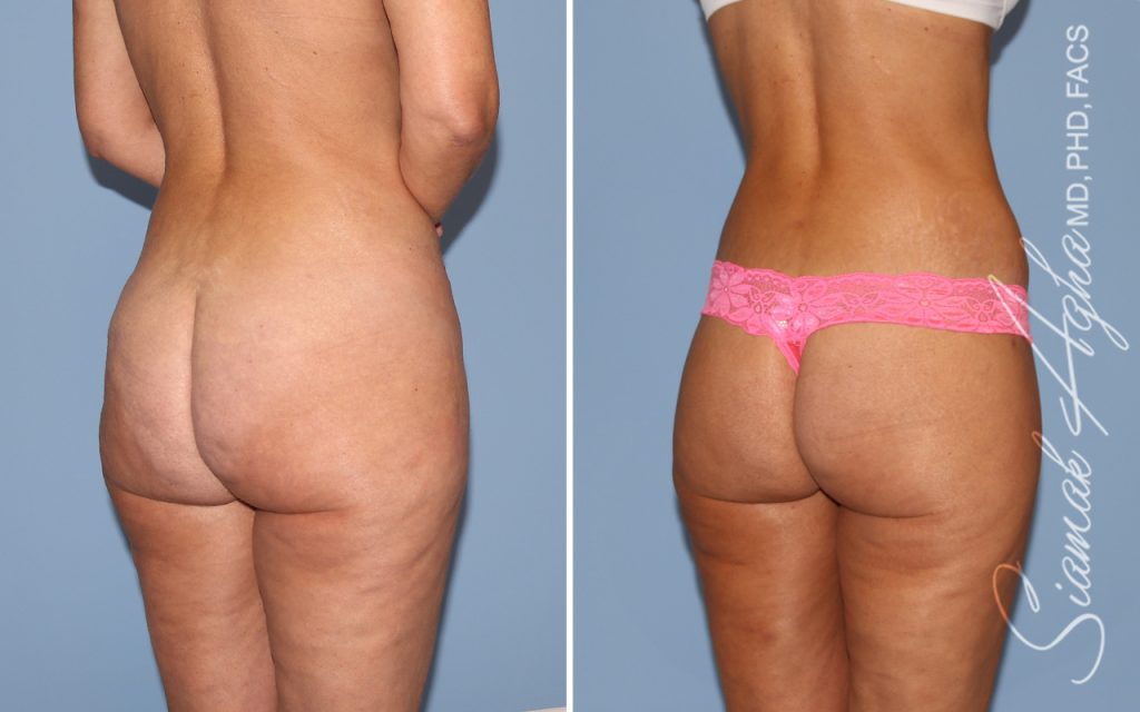 Lower Body Lift Surgery