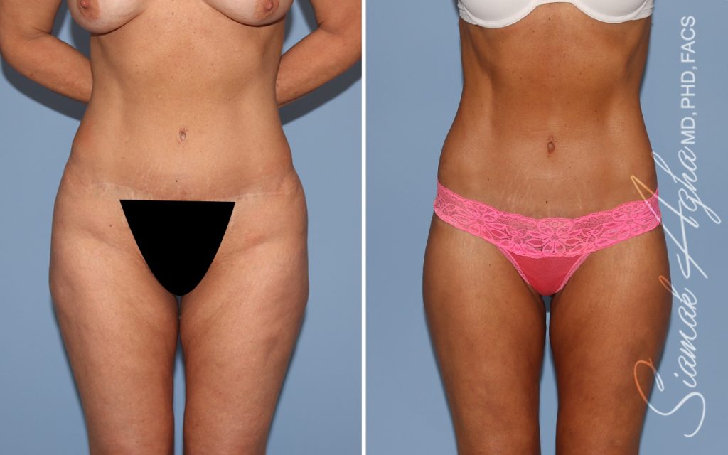 Lower Body Lift Surgery