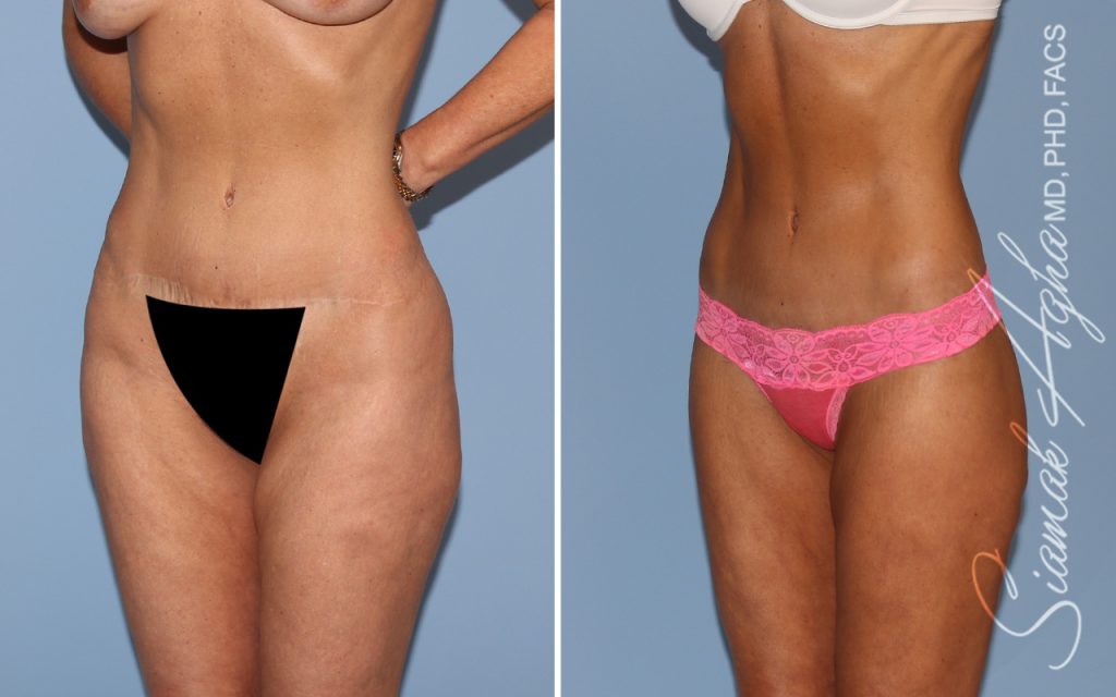 Lower Body Lift Surgery