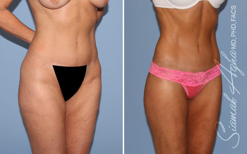 Lower Body Lift Surgery