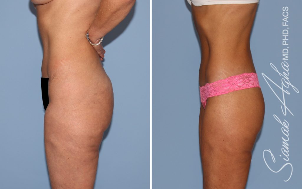 Lower Body Lift Surgery